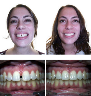 leslie before and after invisalign