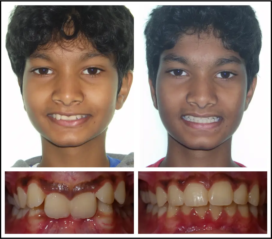 Orthodontic treatment for children