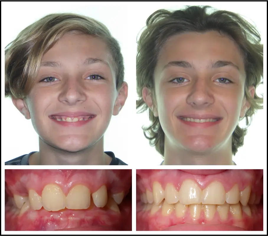 Orthodontic treatment for children