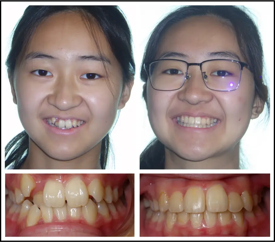 Orthodontic treatment for children