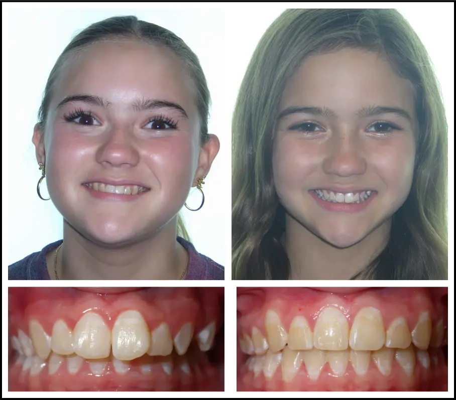 Orthodontic treatment for children