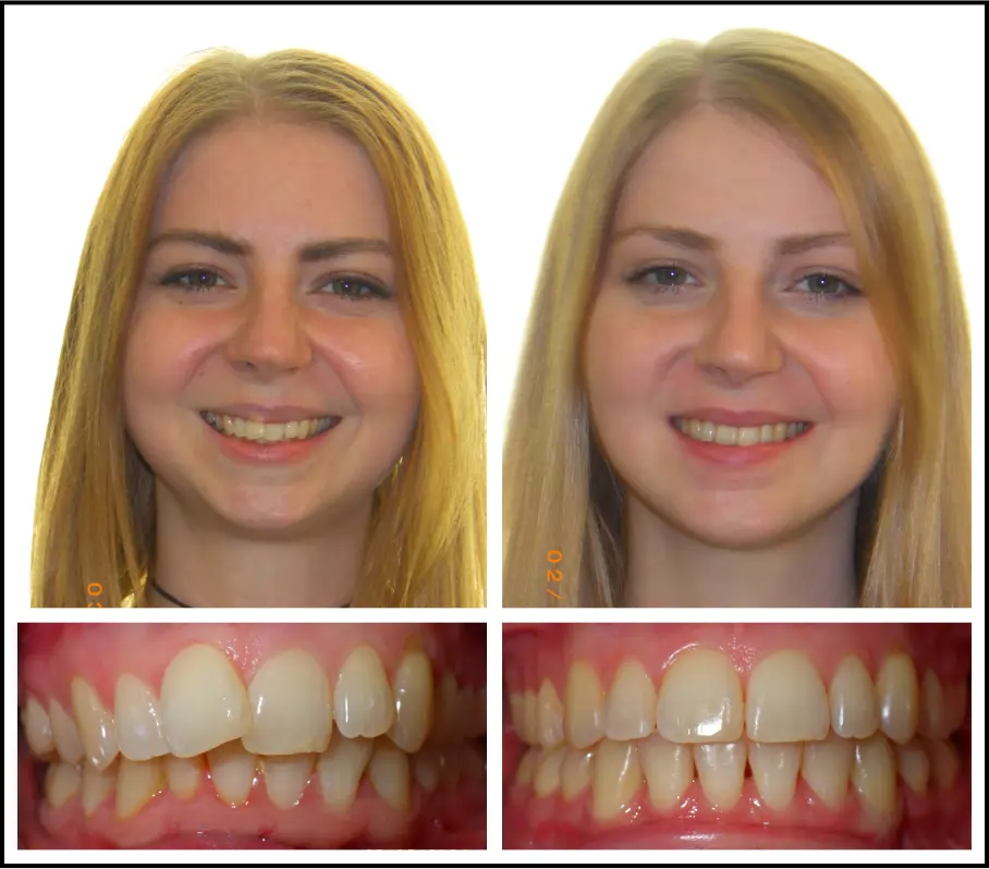 Orthodontic treatment for children