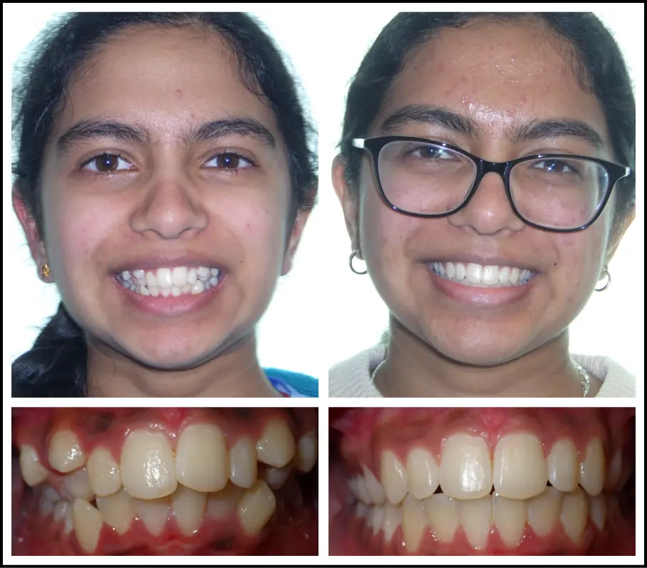 Orthodontic treatment for children